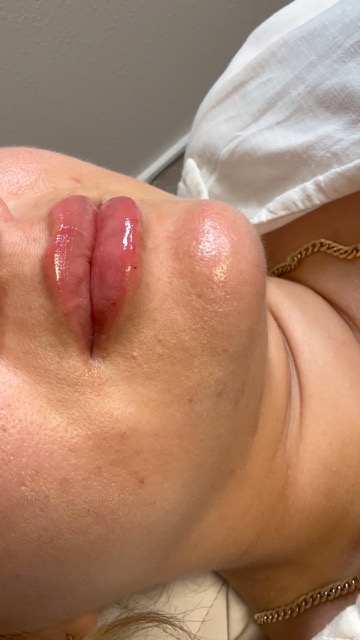 Evolysse treatment at Monroe Aesthetics